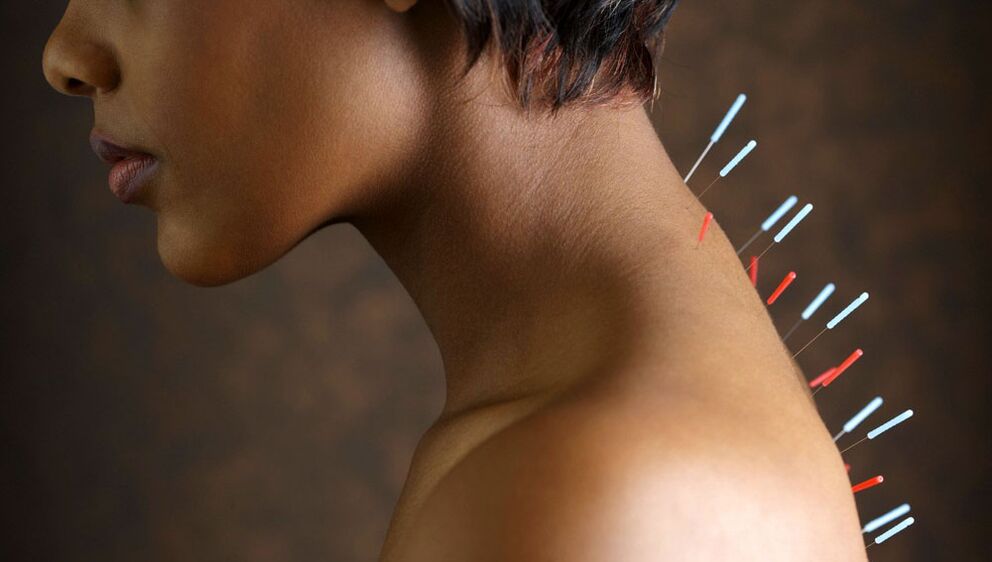 Acupunctuur met cervicale osteochondrose