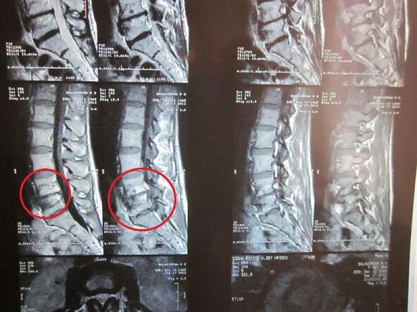 Diagnose van cervicale osteochondrose