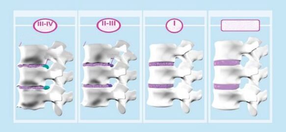 Fasen van cervicale osteochondrose