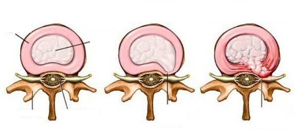intervertebrale hernia met cervicale osteochondrose
