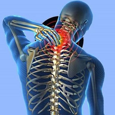 nekpijn met cervicale osteochondrose